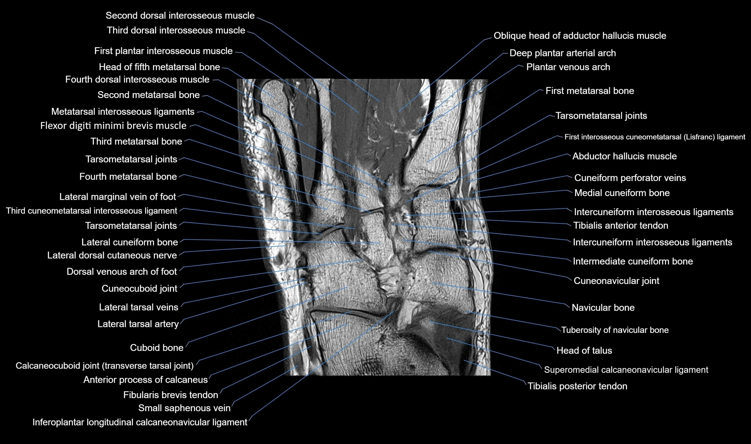 MRI mid foot coronal ligaments cross sectional anatomy 3T  radiology  image-img-00001-00023.webp